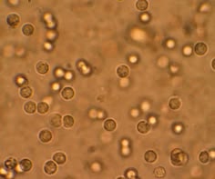 Mikroskopija sedimenta urina
